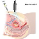 amniocentesi-schema